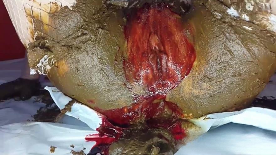 Anna Coprofield – Shit and Blood Vol.6 Filled Pussy Part 2